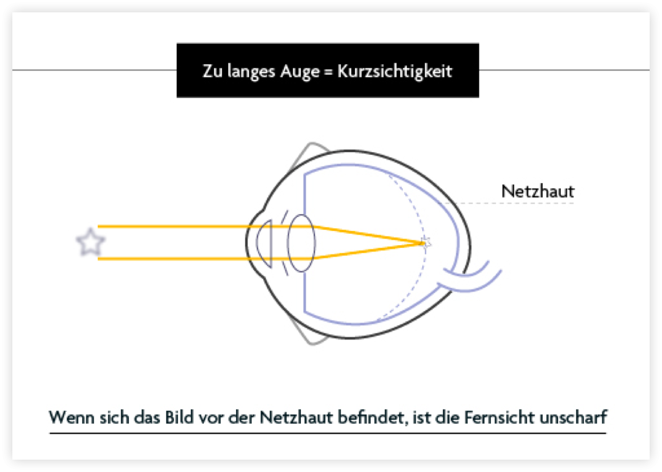 Optic2000 Myopie Schema 1 De (2)