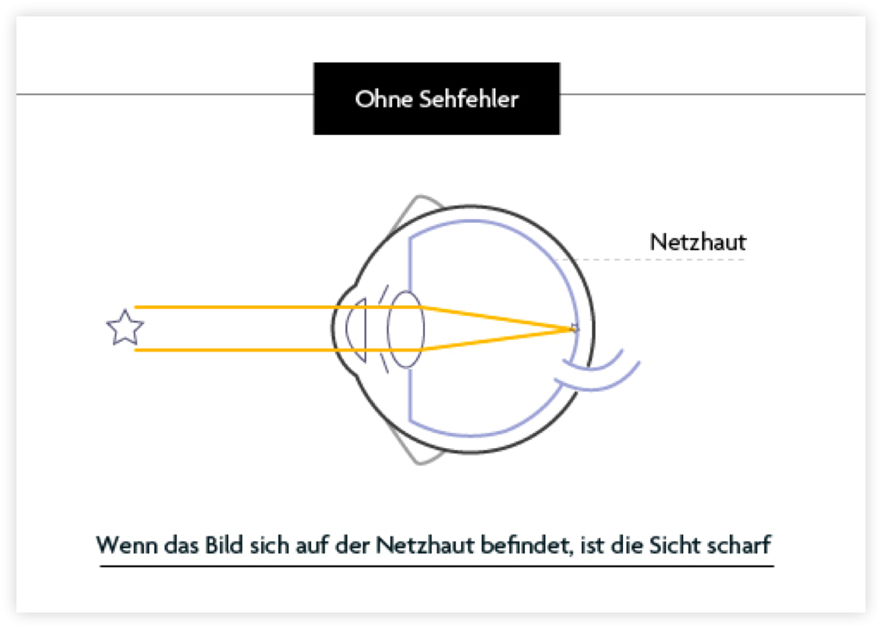 Optic2000 Myopie Schema 2 De (2)